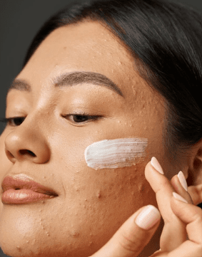 Aichun Beauty - Acne Treatment Gel - Zambeel