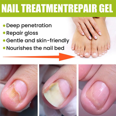 EELHOE - Nail Treatment Repair Gel - Zambeel