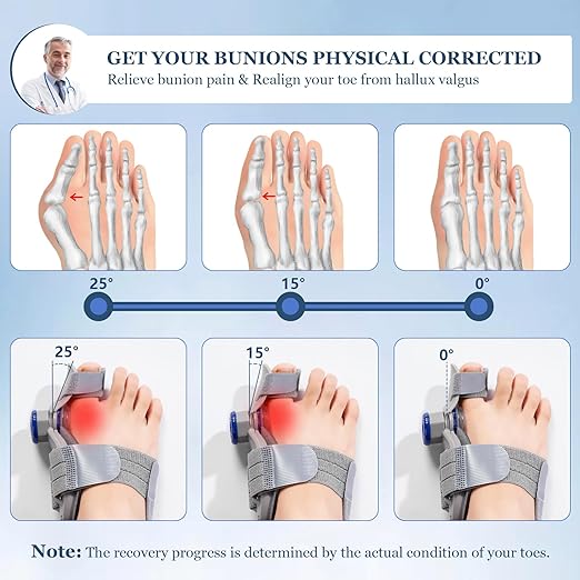 FeetifFix - Bunion Corrector - Zambeel