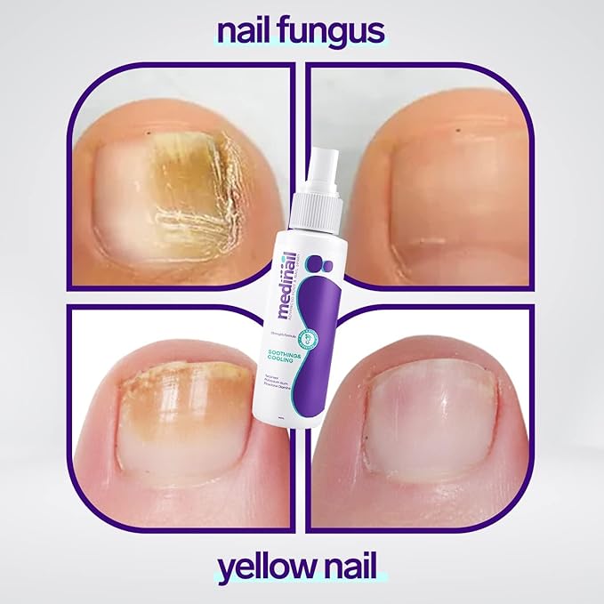 Jaysuin - Nail Fungus Spray (Original) - Zambeel