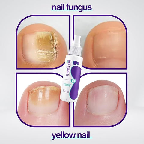 Jaysuin - Nail Fungus Spray (Original) - Zambeel