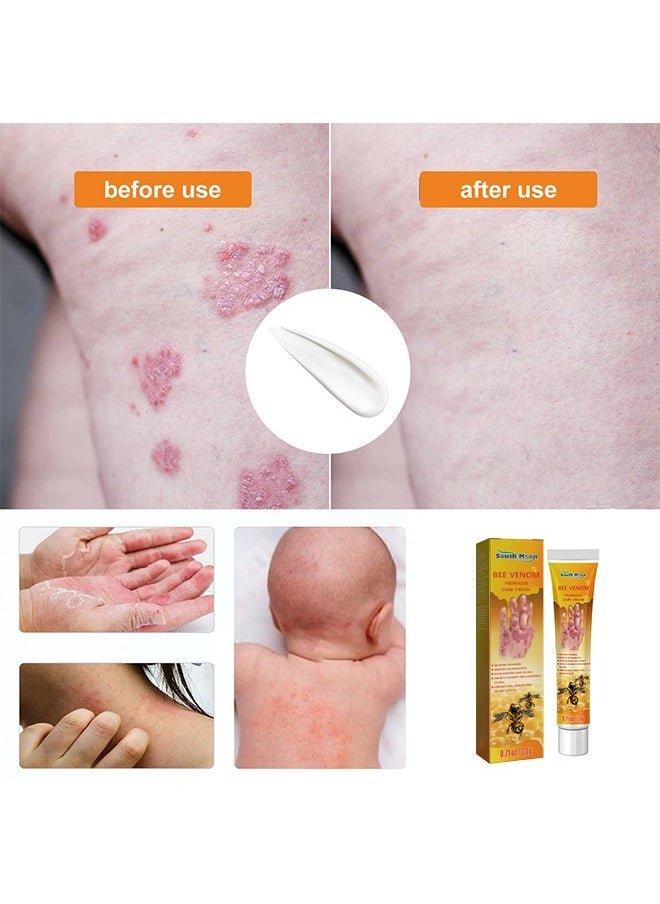 South Moon - Bee Venom Psoriasis Care Cream - Zambeel