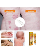 South Moon - Bee Venom Psoriasis Care Cream - Zambeel