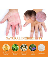 South Moon - Bee Venom Psoriasis Care Cream - Zambeel