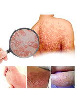 South Moon - Bee Venom Psoriasis Care Cream - Zambeel