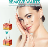West & Month - Skin Tag Remover - Zambeel